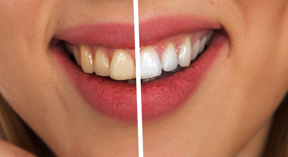 Estos son los riesgos de blanquear tus dientes con carbón activado