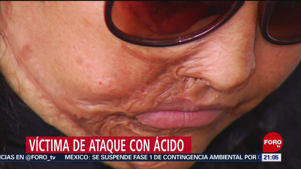 Foto: Víctima Ataque Ácido Expareja Historias Mujeres Atacadas Acido 11 de Abril 2019