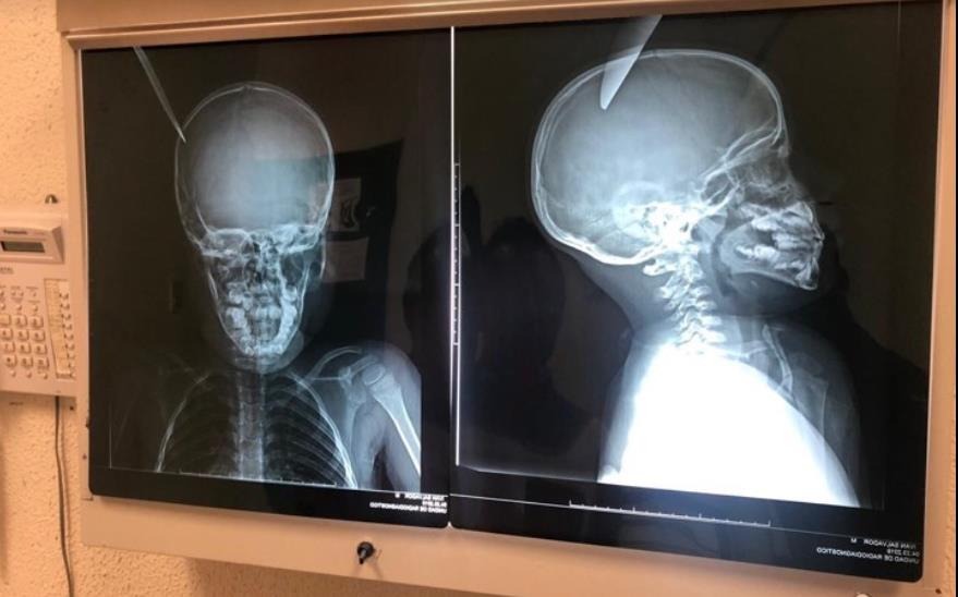 Foto: Radiografía del menor apuñalado en la cabeza. El 24 de abril de 2019