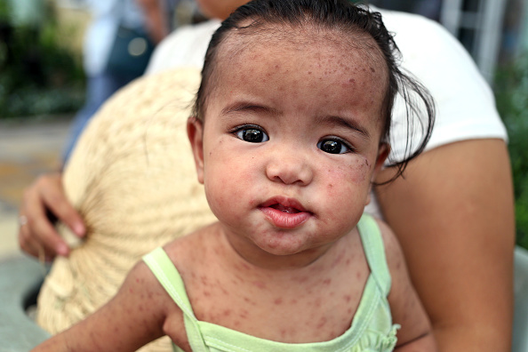 Fotografía de un niño con sarampión, 10 abril 2019