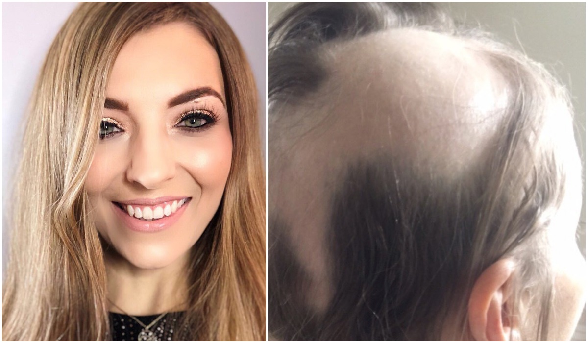 Novia pierde el cabello tras el estrés de su boda