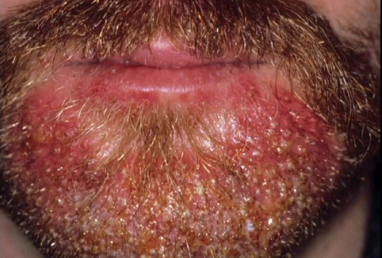 Barba abundante, una moda que podría concentrar microbios, parásitos y hasta piojos