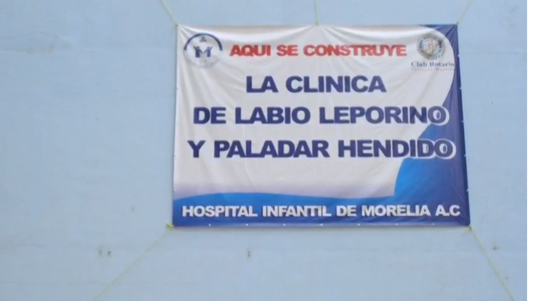 Foto: Clínica labio leporino y paladar hendido en Michoacán, junio de 2019, México