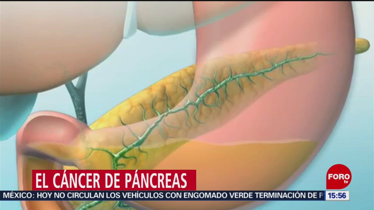 Foto: El cáncer de páncreas
