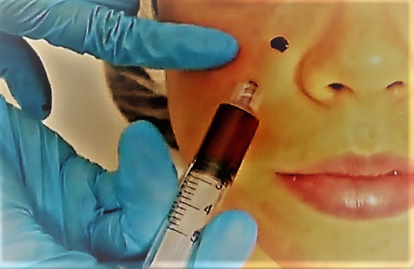 Facial Vampiro: Advierten aplicación de este peligroso tratamiento estético en México por inexpertos