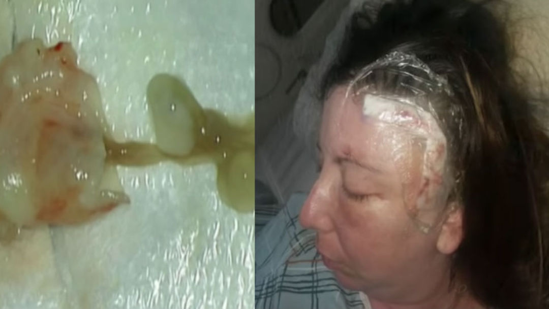 Foto Mujer vivía con un gusano en el cerebro 6 junio 2019