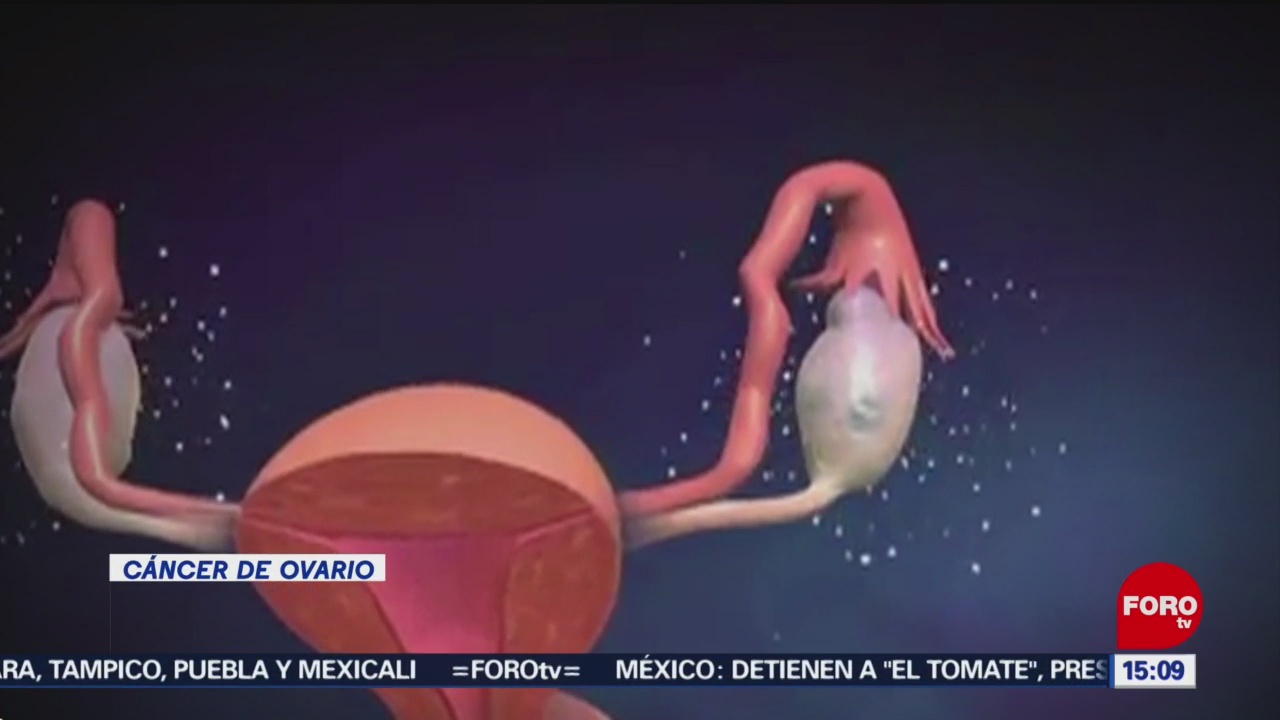 Foto: Qué es el cáncer de ovario
