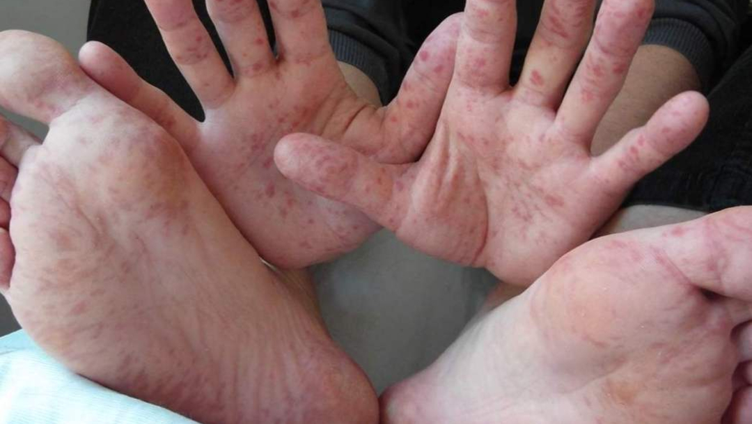 Imagen: El virus de Coxsackie puede generar ampollas en pies y manos, 3 de julio de 2019 (Foto: Vimeo)