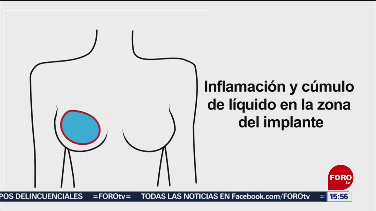 Foto: Cáncer asociado implantes mamarios