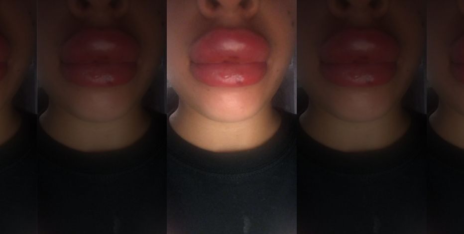 mujeres con labios inyectados arizona