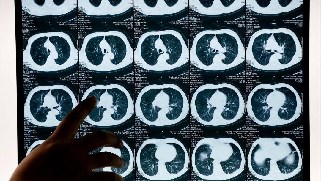 Foto: Estudio sobre cáncer de pulmón, 8 de diciembre de 2016, China