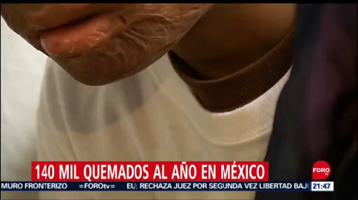 Quemaduras por pirotecnia en México