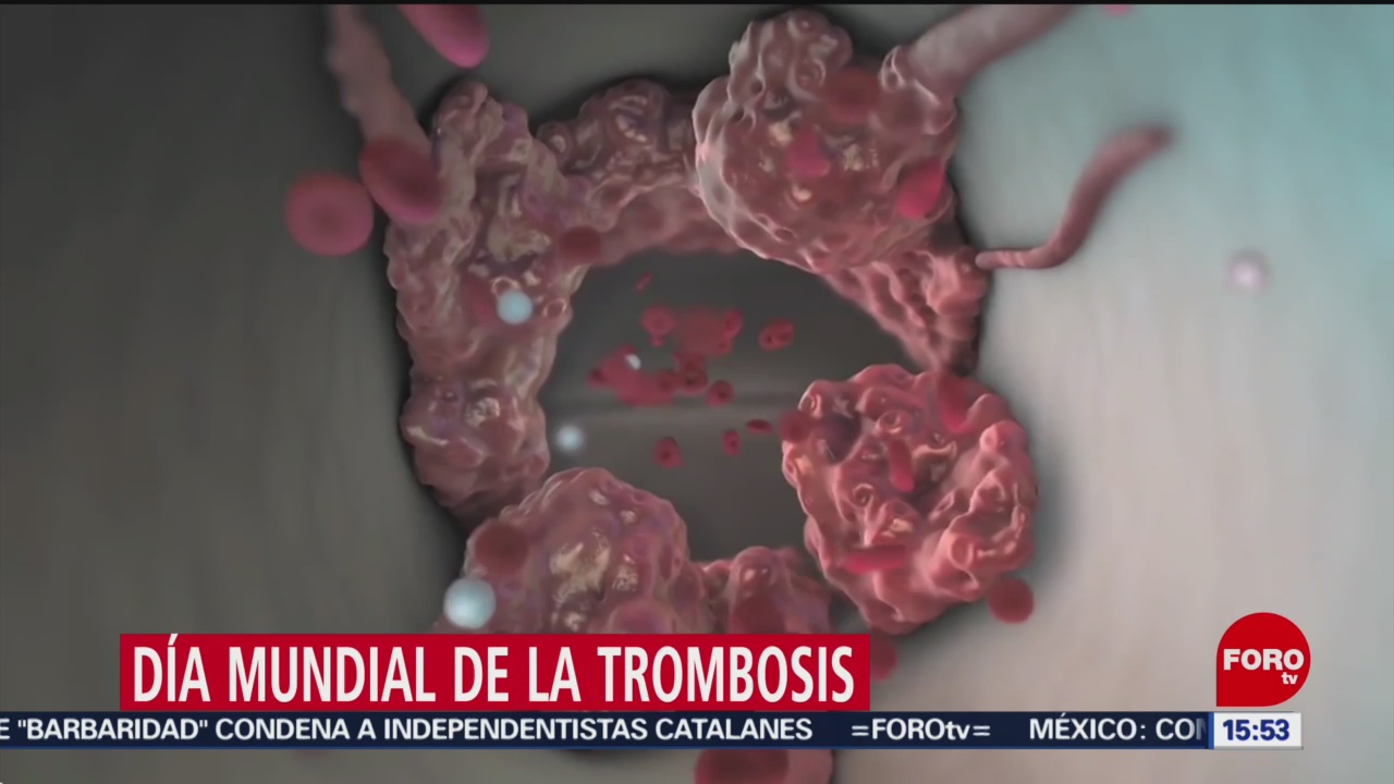FOTO: Trombosis responsable 25 muertes México