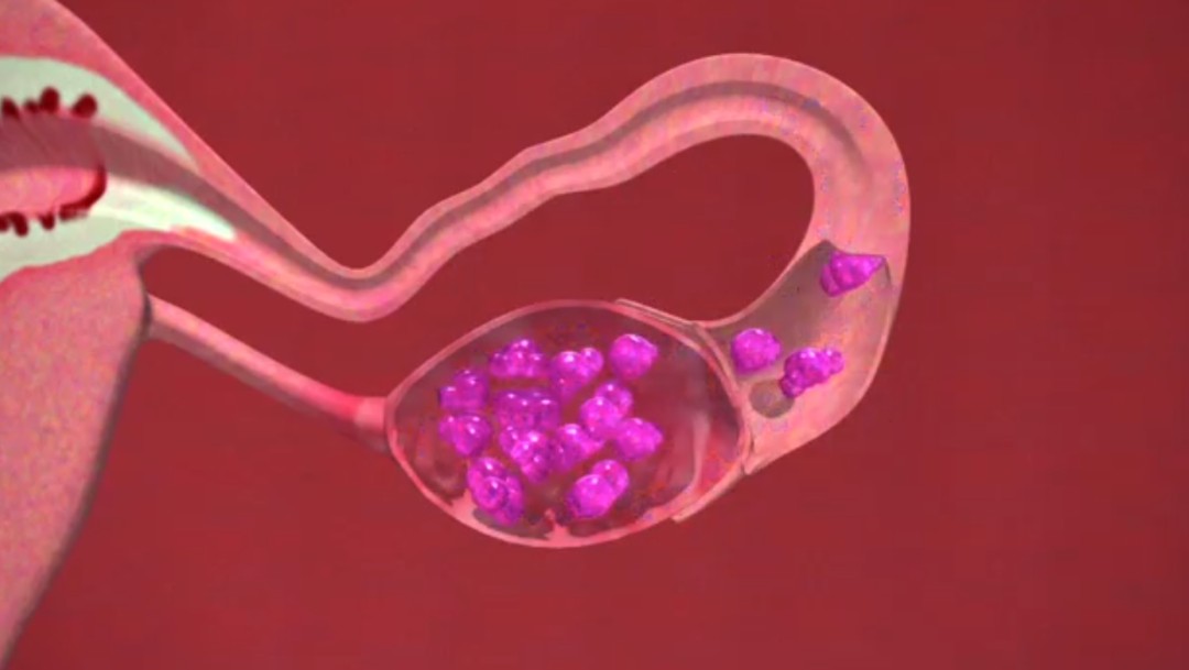 Foto: Síntomas digestivos pueden ser principios de cáncer de ovario