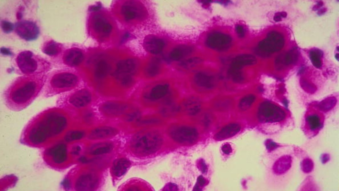 Foto: Descubren proteína que elimina metástasis de cáncer de mama 30 de enero de 2020(American Cancer Society/Getty Images), archivo)