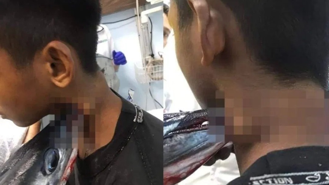 Foto: Pez espada atraviesa el cuello y cráneo de un joven en Indonesia 