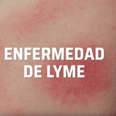 ¿Qué es y cuáles son los síntomas de la enfermedad de Lyme?