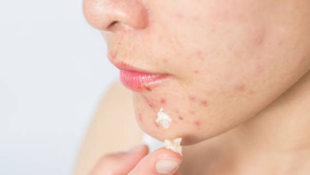 Remedios caseros agravan cuadro de acné, dice especialista