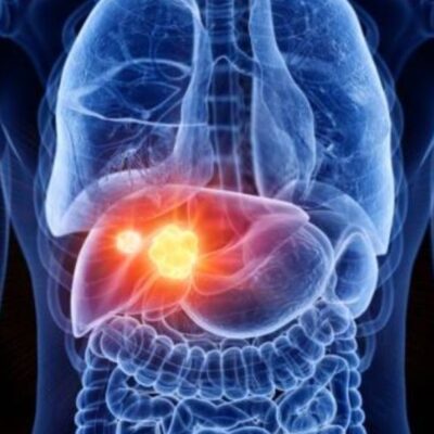 Identifican los mecanismos que bloquean las etapas previas del cáncer de hígado