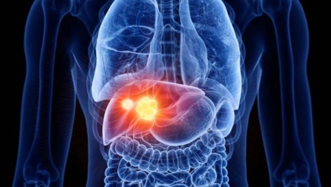 Cómo detectar a tiempo el cáncer de hígad