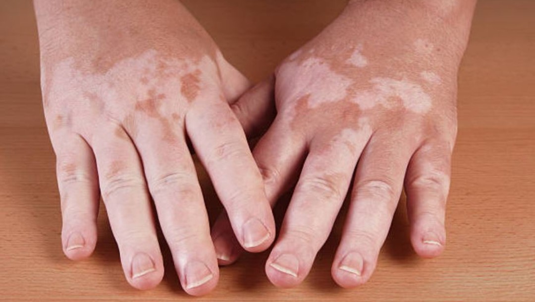 ¿Qué es y por qué se produce el Vitiligo?
