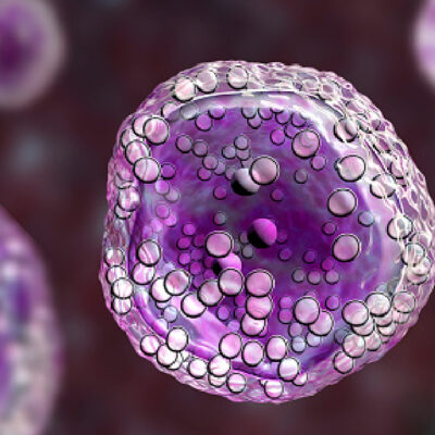 Células madre podrían salvar a pacientes con neumonía por coronavirus