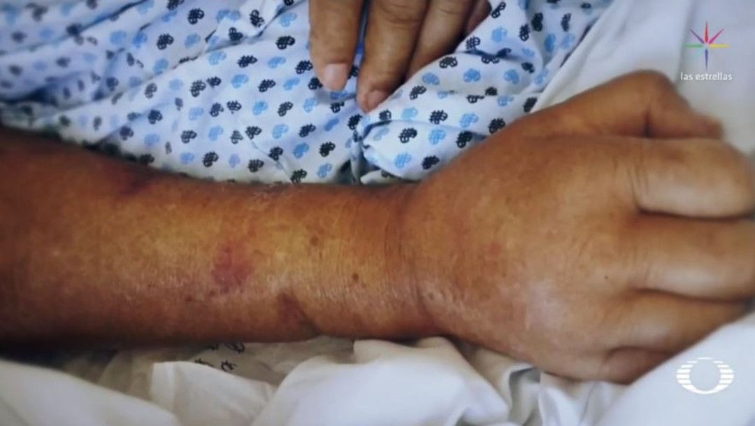 Foto: Uno de los pacientes, de 75 años de edad, ingresó para una recolocación de catéter y continuar con sus terapias de diálisis peritonial, sin embargo, este miércoles fue declarado con muerte cerebral