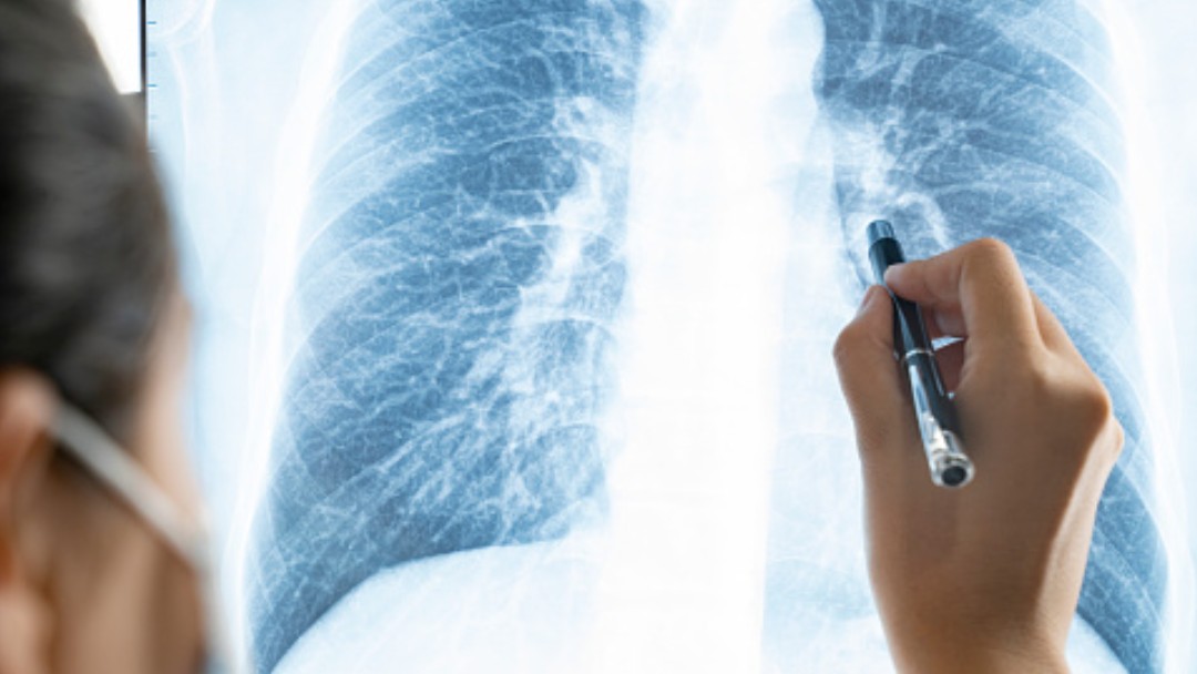 Una doctora revisa una radiografía de pulmones. Getty Images