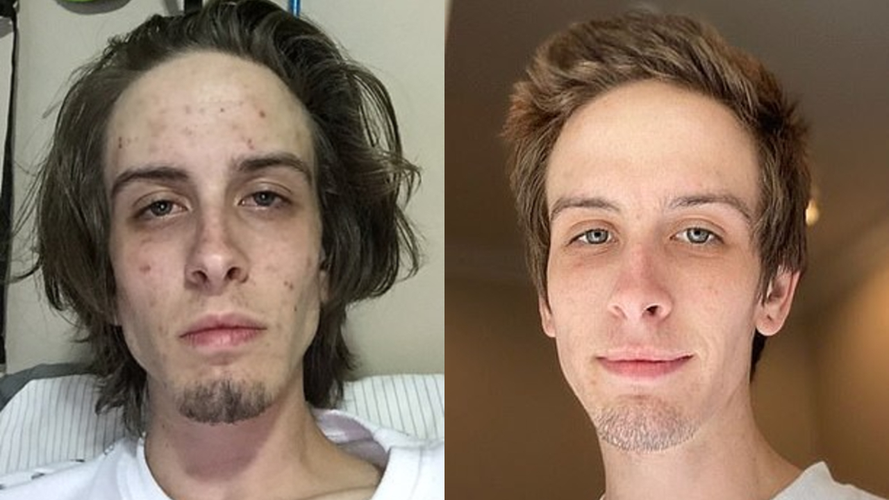 Fotos comparando a un adicto antes y después de dos años de estar sobrio.