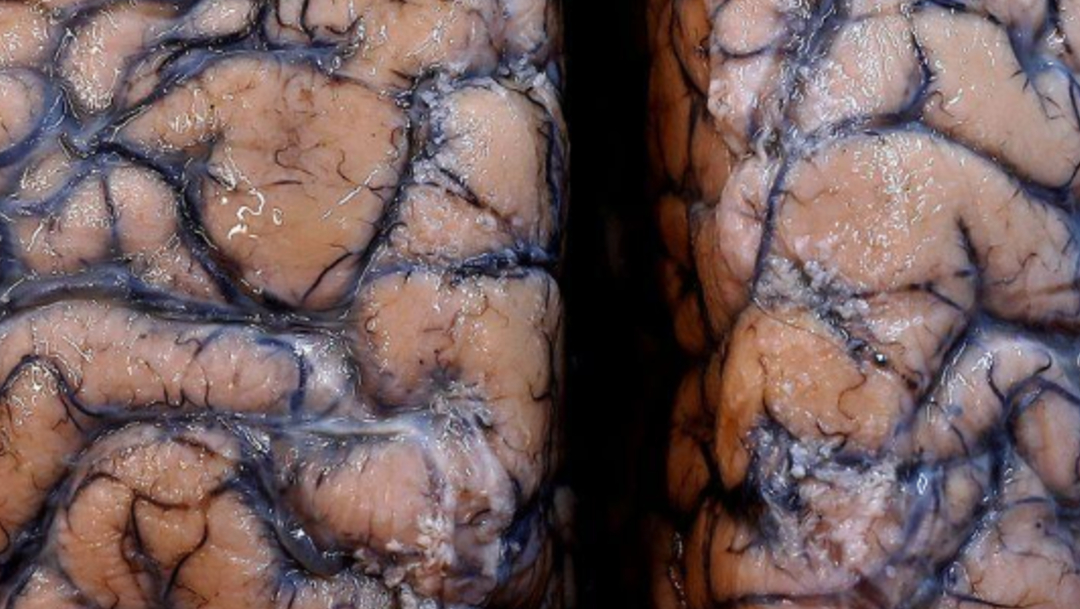Cerebro humano, científicos advierten de lesiones cerebrales relacionadas al COVID-19