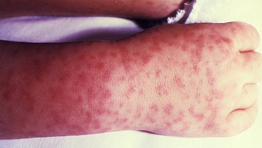 Fotografía que muestra la mano de una niños con picaduras de pulgas, garrapatas o piojos.