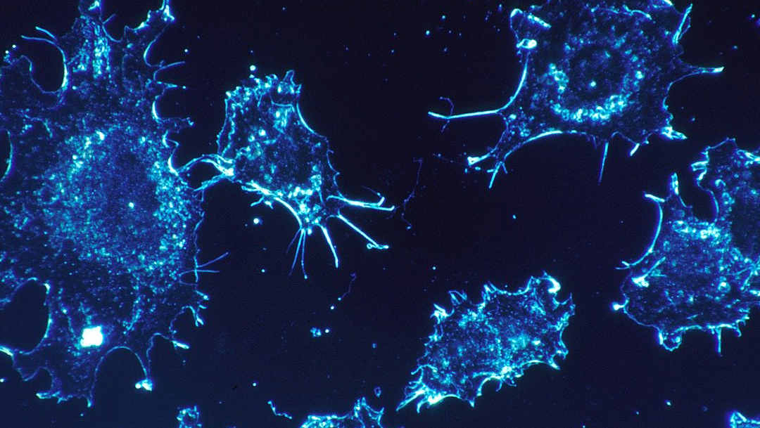 Los científicos encontraron la relación importante entre la falta de oxígeno a los tumores cancerosos y la metástasis