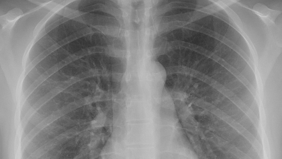 Pacientes que han vencido al COVID-19 presentan fatiga crónica y daños en el pulmón, según estudio de la Universidad del Sur de California