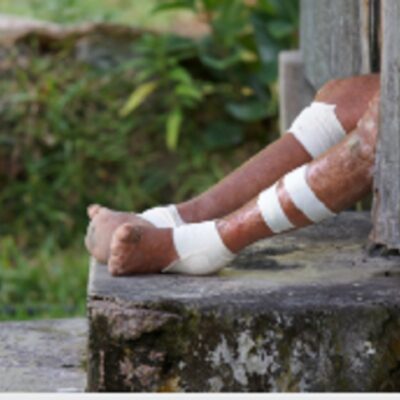 Reportan cinco casos de lepra en Yucatán y Quintana Roo