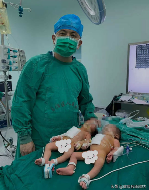 En China, operaron a unas gemelas que estaban unidas por el estómago y fueron sometidas a una cirugía a pesar de tener un día