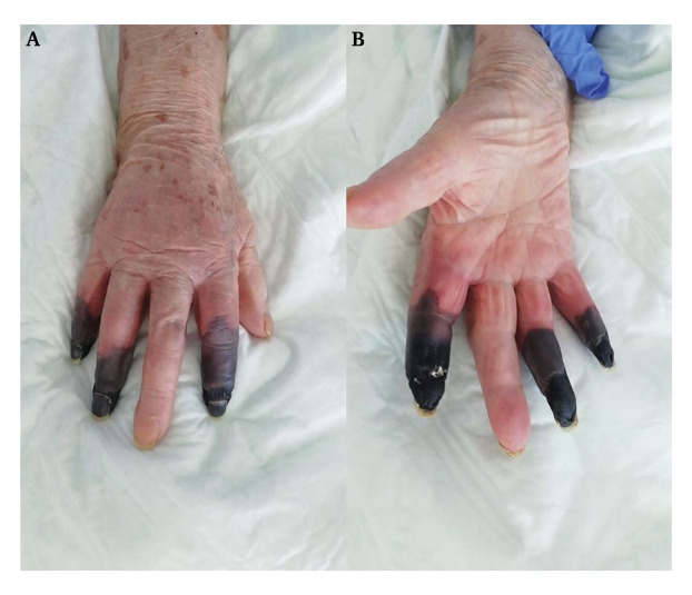 Mujer de 86 sufre amputación de tres dedos por covid