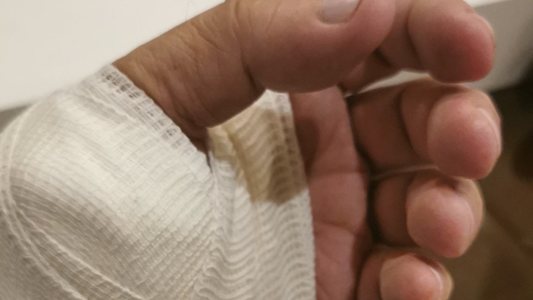 Ebrard acude a urgencias, lo suturan de una cortada en la mano