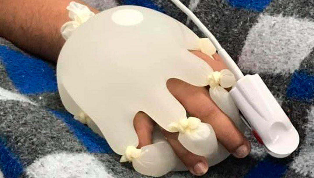 Enfermera en Brasil crea guantes especiales para calmar pacientes con covid