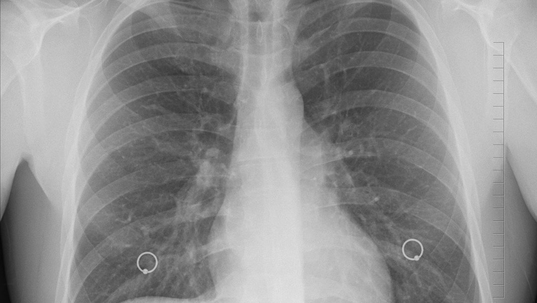 Reportan casos tuberculosis Guanajuato durante pandemia