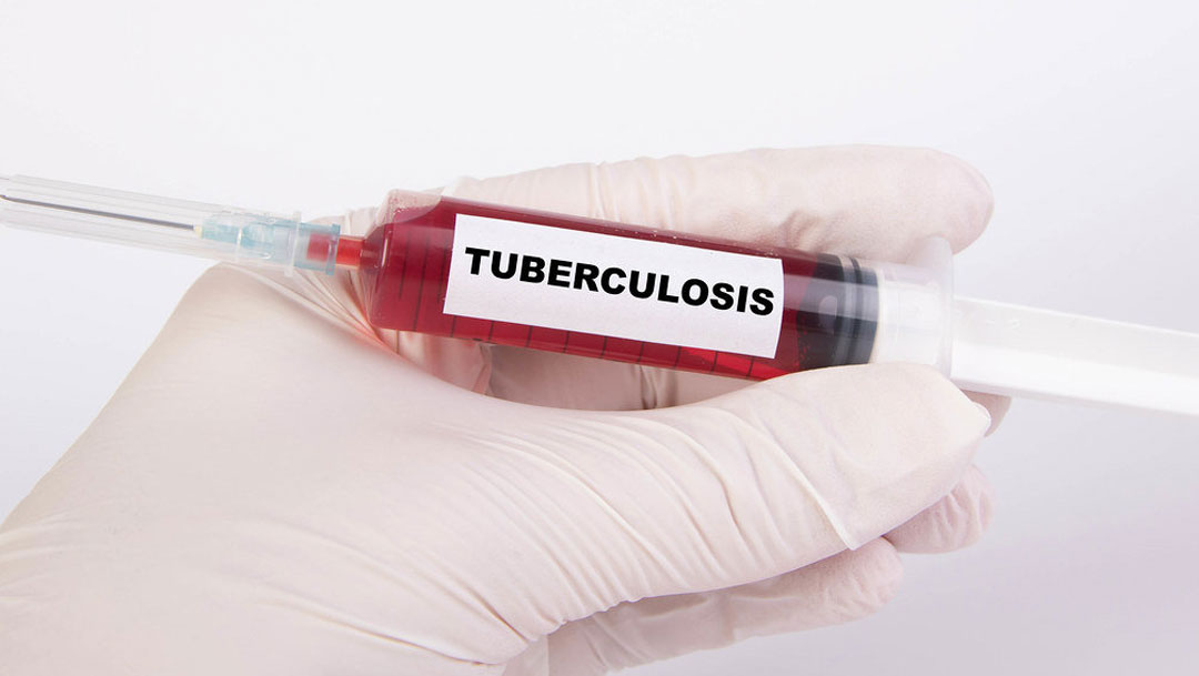 Reportan casos tuberculosis Guanajuato durante pandemia