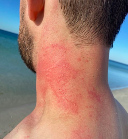 Pulpo ataca a bañista en playa de Australia