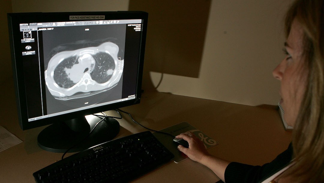 Una tomografía computarizada de un pulmón (Getty Images)