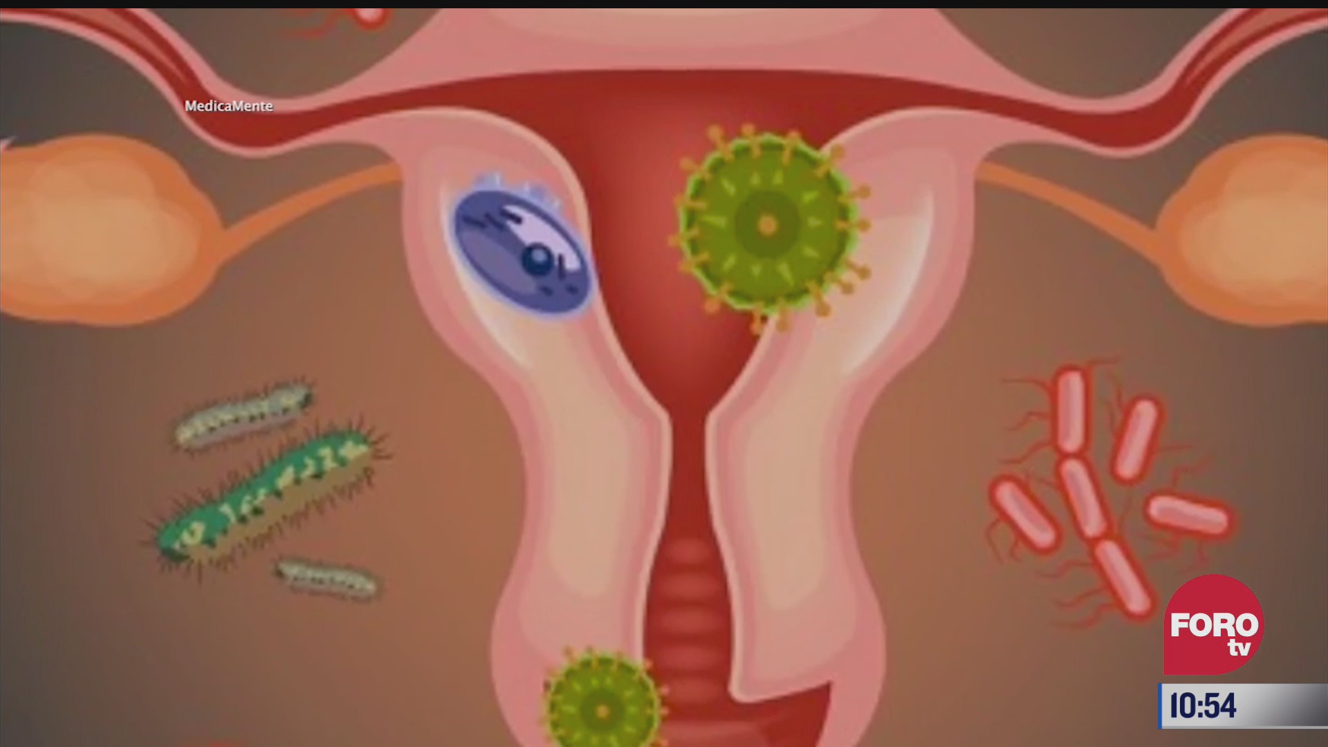que es vaginosis bacteriana