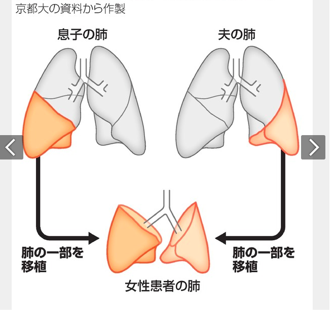 Realizan en Japón primer trasplante de pulmón de donante vivos a paciente con daños por COVID