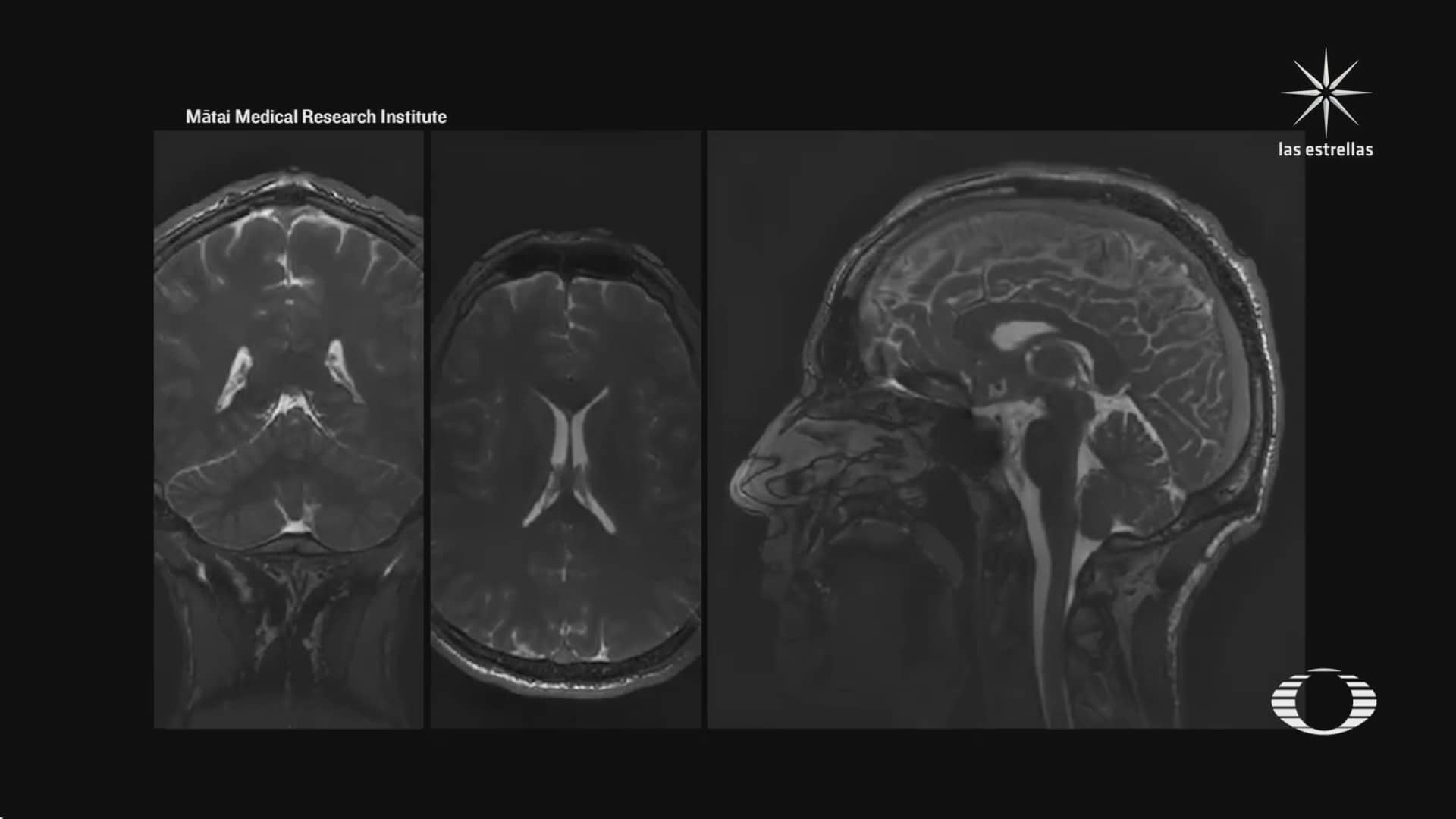 desarrollan resonancia magnetica cerebral en 3d capaz de detectar aneurismas