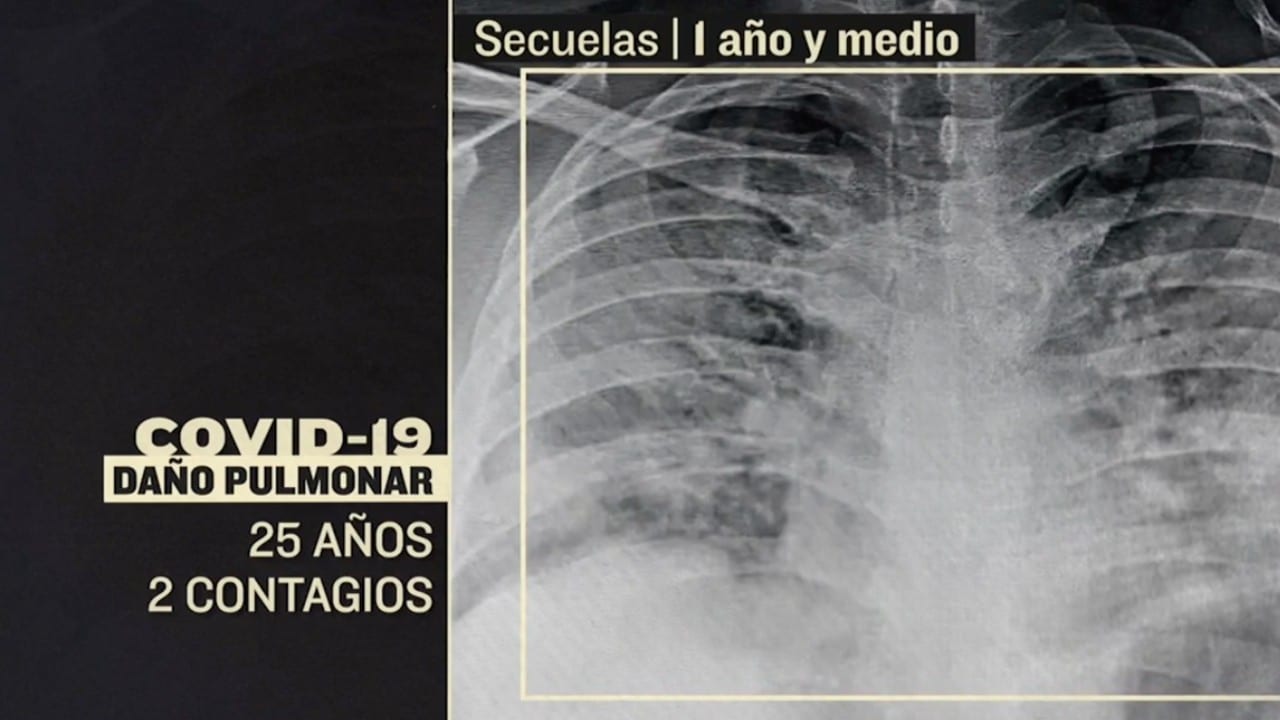 Vacunarse contra COVID podría evitar un daño grave en pulmones tras contagio