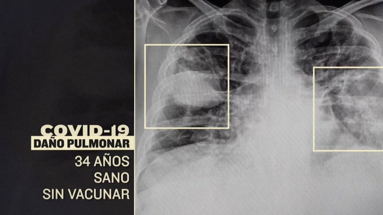 Vacunarse contra COVID podría evitar un daño grave en pulmones tras contagio
