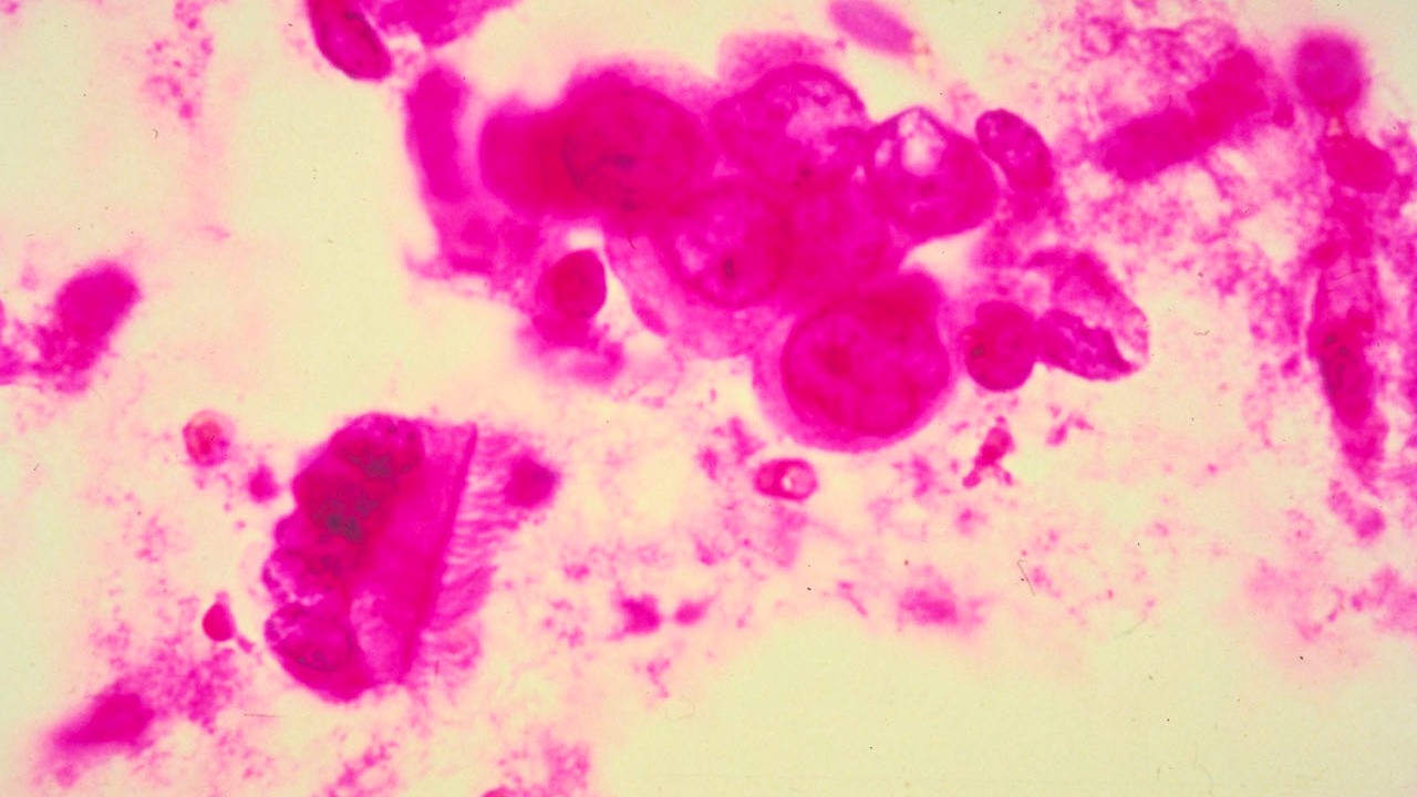 Células cancerígenas (Getty Images)