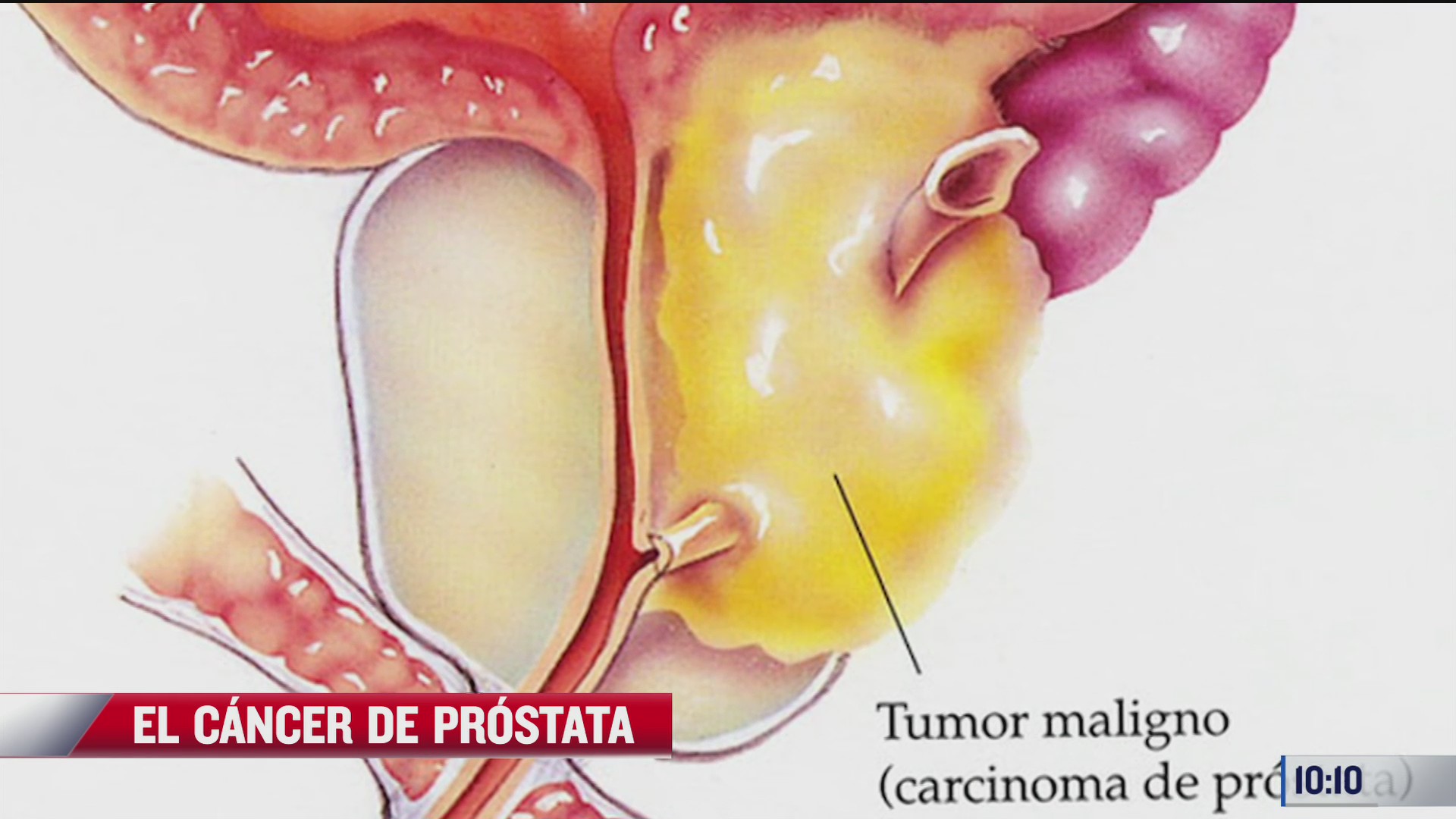 cancer de prostata el mas comun en los hombres