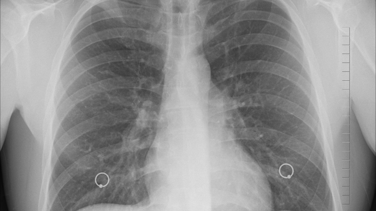Cáncer de pulmón incrementa hasta en 34% el riesgo de contraer covid grave, dice especialista